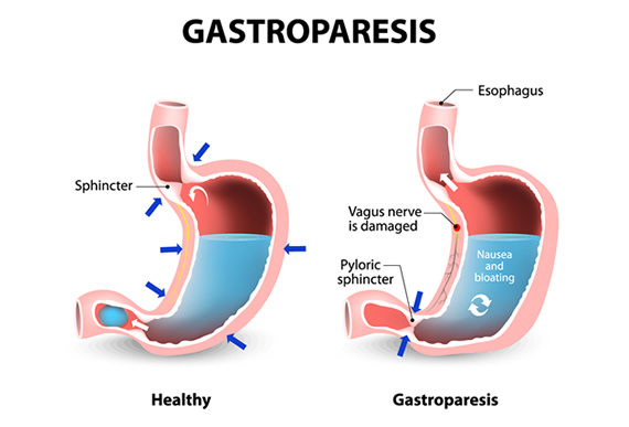Can Omeprazole Cause Gastroparesis