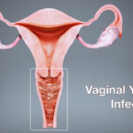 Does canex V help yeast infections