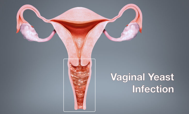 Does canex V help yeast infections