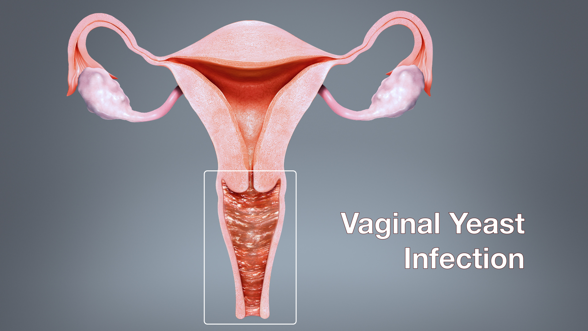 Does canex V help yeast infections