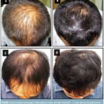 What Finasteride 12 Month Results Looks Like