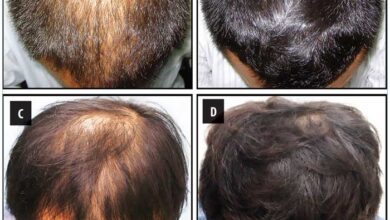 What Finasteride 12 Month Results Looks Like