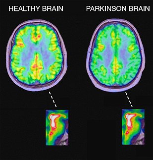 Drug induced Parkinsonism