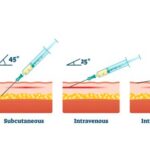 Giving Subcutaneous Injection Intramuscularly