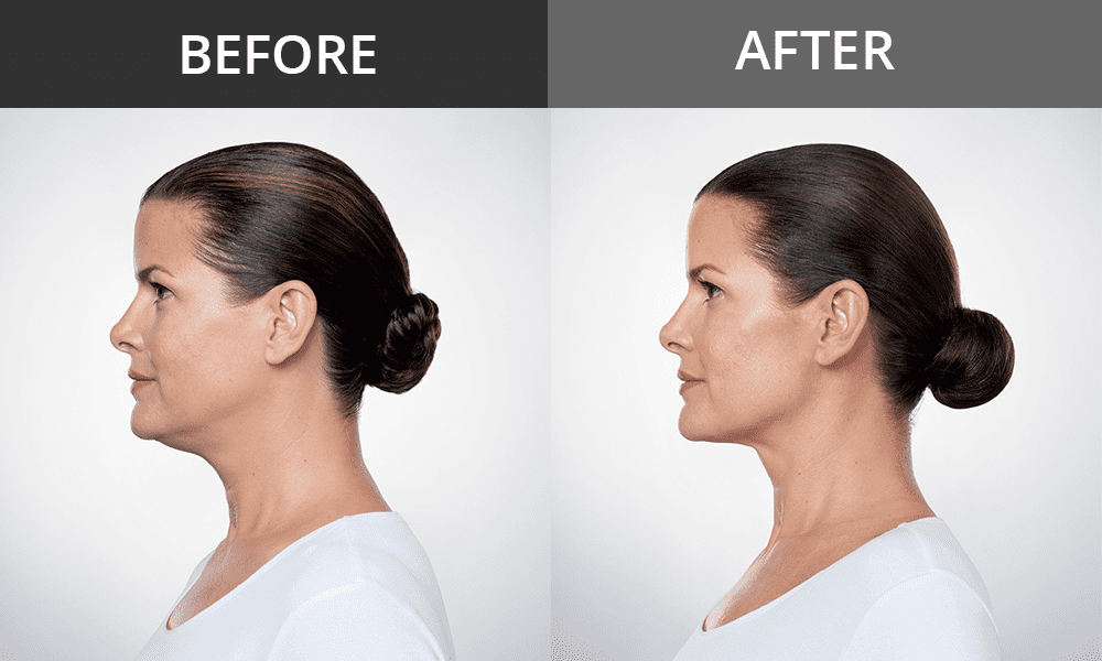 How Long Does Kybella Last