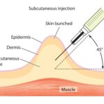 Why Are Subcutaneous Injections Given At A 45 Degree Angle