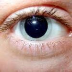 What Drugs Cause Dilated Pupils