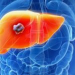 HLB's Liver Cancer Drug Gets FDA’s Orphan Drug Status