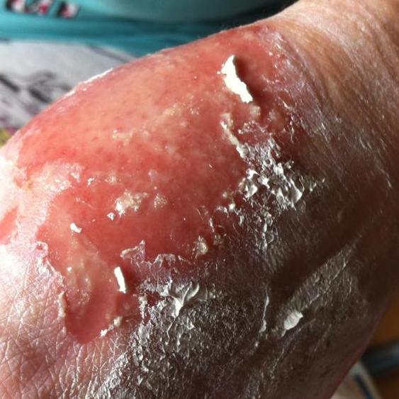 steven johnson syndrome picture