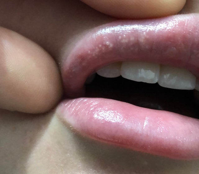 Will Juvederm Bumps Go Away