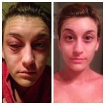 Bactrim allergic reaction before and after