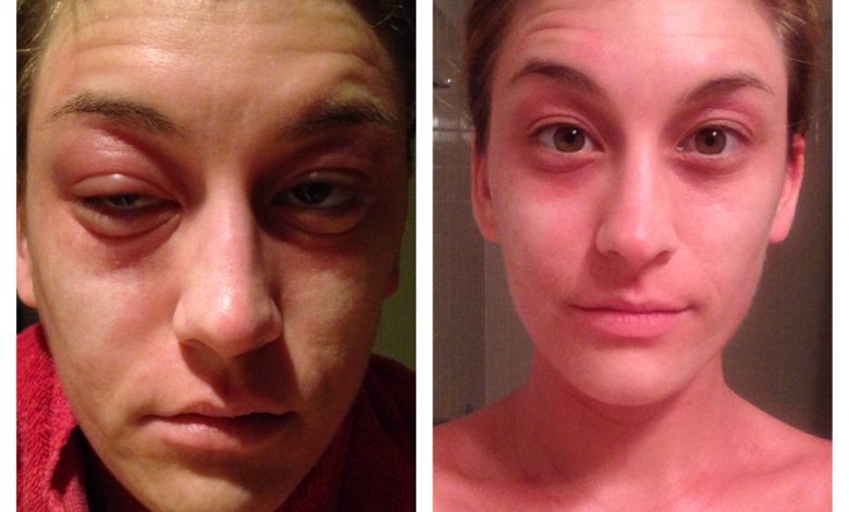 Bactrim allergic reaction before and after