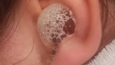 Can you put hydrogen peroxide in your ear2