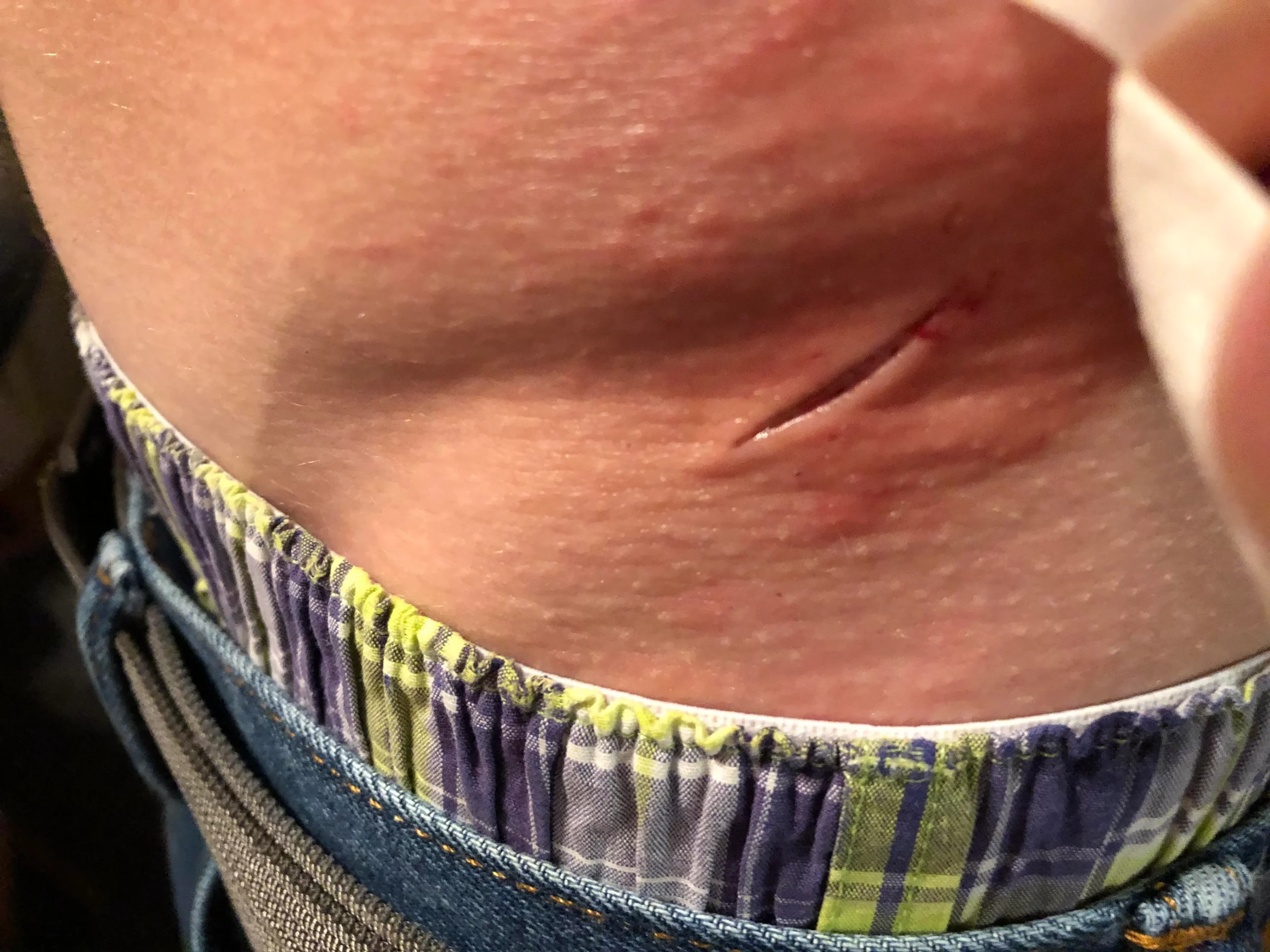 When To Get A Tetanus Shot After A Cut scaled