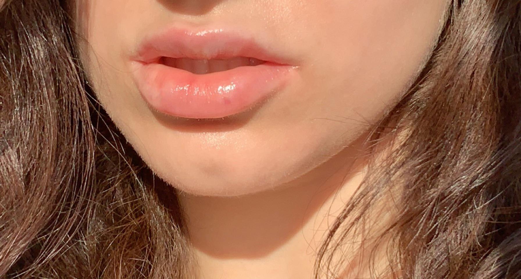 How To Cover Bruises From Filler Injections Meds Safety