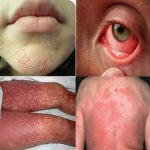 photo of allergic reaction to doxycycline