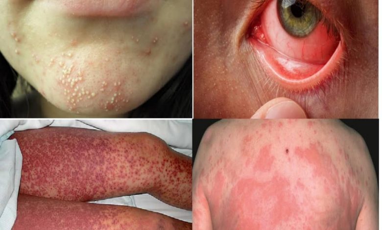 photo of allergic reaction to doxycycline 1
