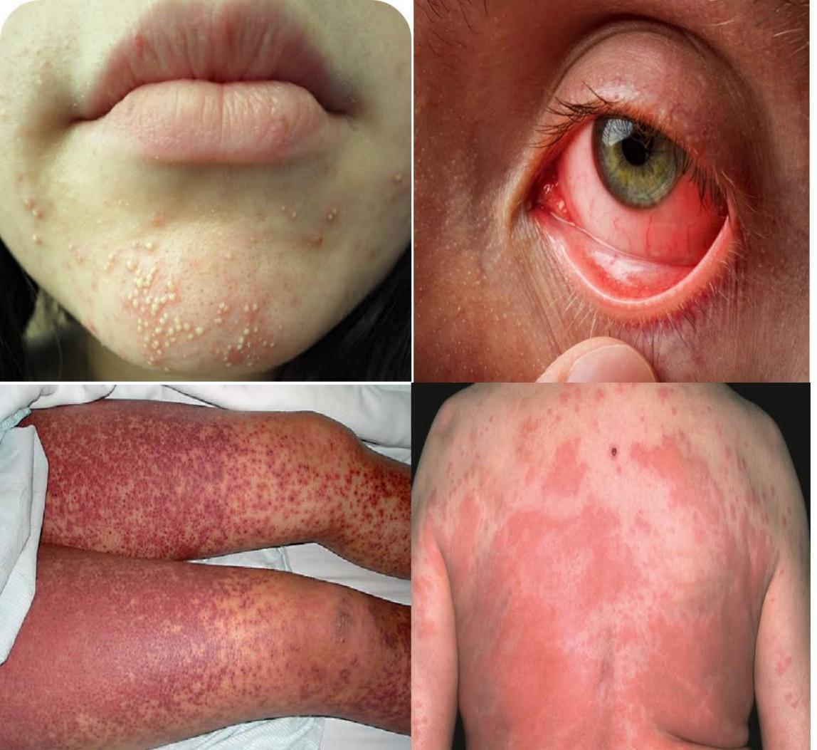 photo of allergic reaction to doxycycline 1