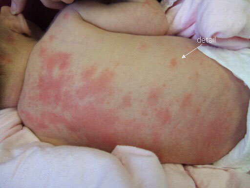 photo of allergic reaction to doxycycline