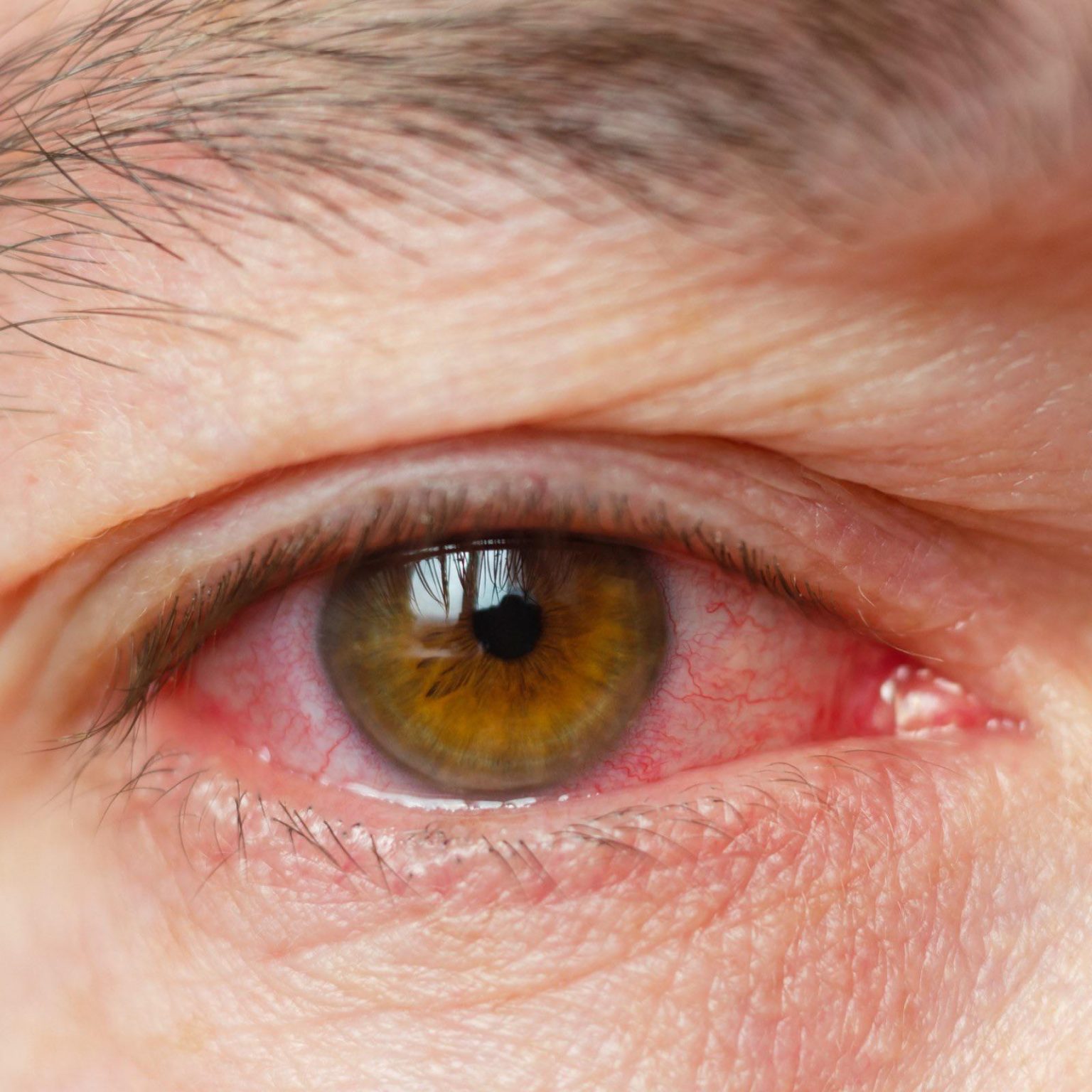 3 Major Jardiance Side Effects On Eyes - Meds Safety