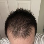 Does Spironolactone Cause Hair Loss scaled