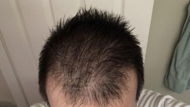 Does Spironolactone Cause Hair Loss scaled