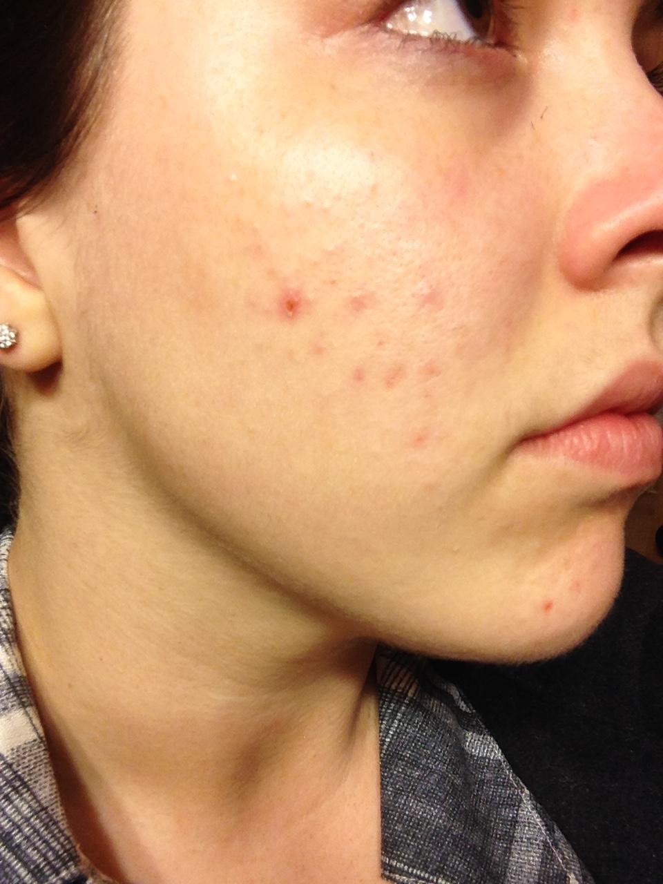 Does Xanax Cause Acne