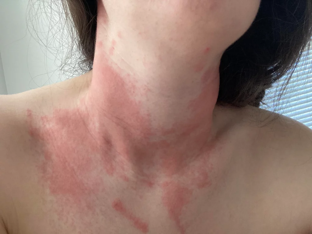 pictures of Allergic Reaction to Doxycycline