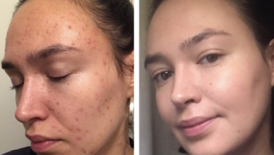 How Long Does Spironolactone Take To Work For Acne