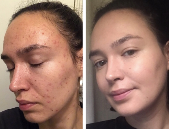 How Long Does Spironolactone Take To Work For Acne