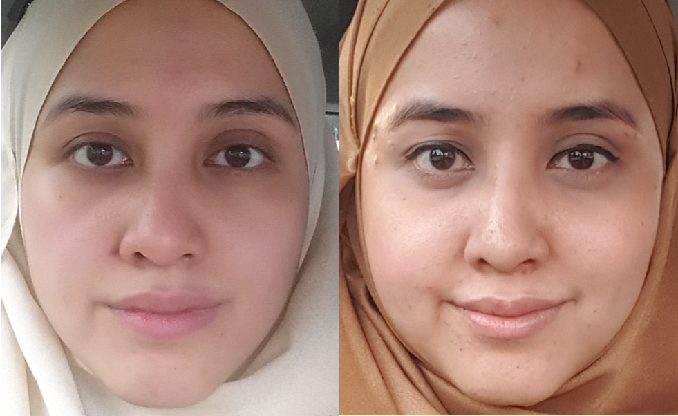 How To Prevent Moon Face From Prednisone