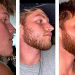 Minoxidil Beard Before And After Photos