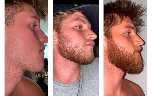Minoxidil Beard Before And After Photos - Meds Safety