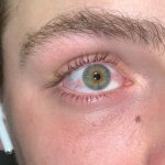 What does Xanax do to your eyes