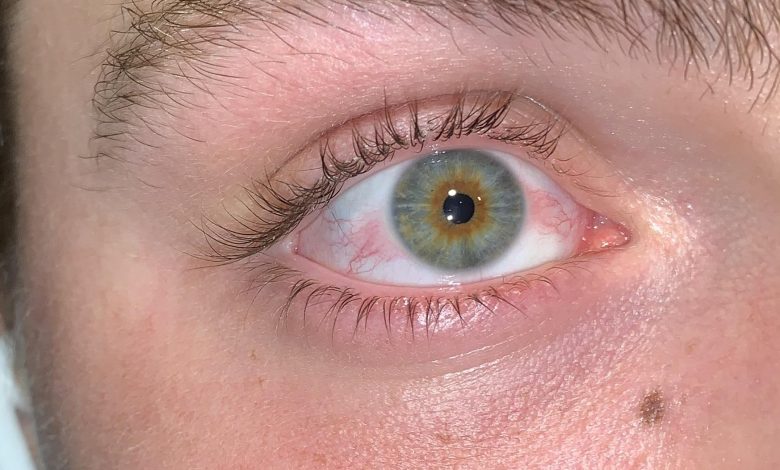 What does Xanax do to your eyes