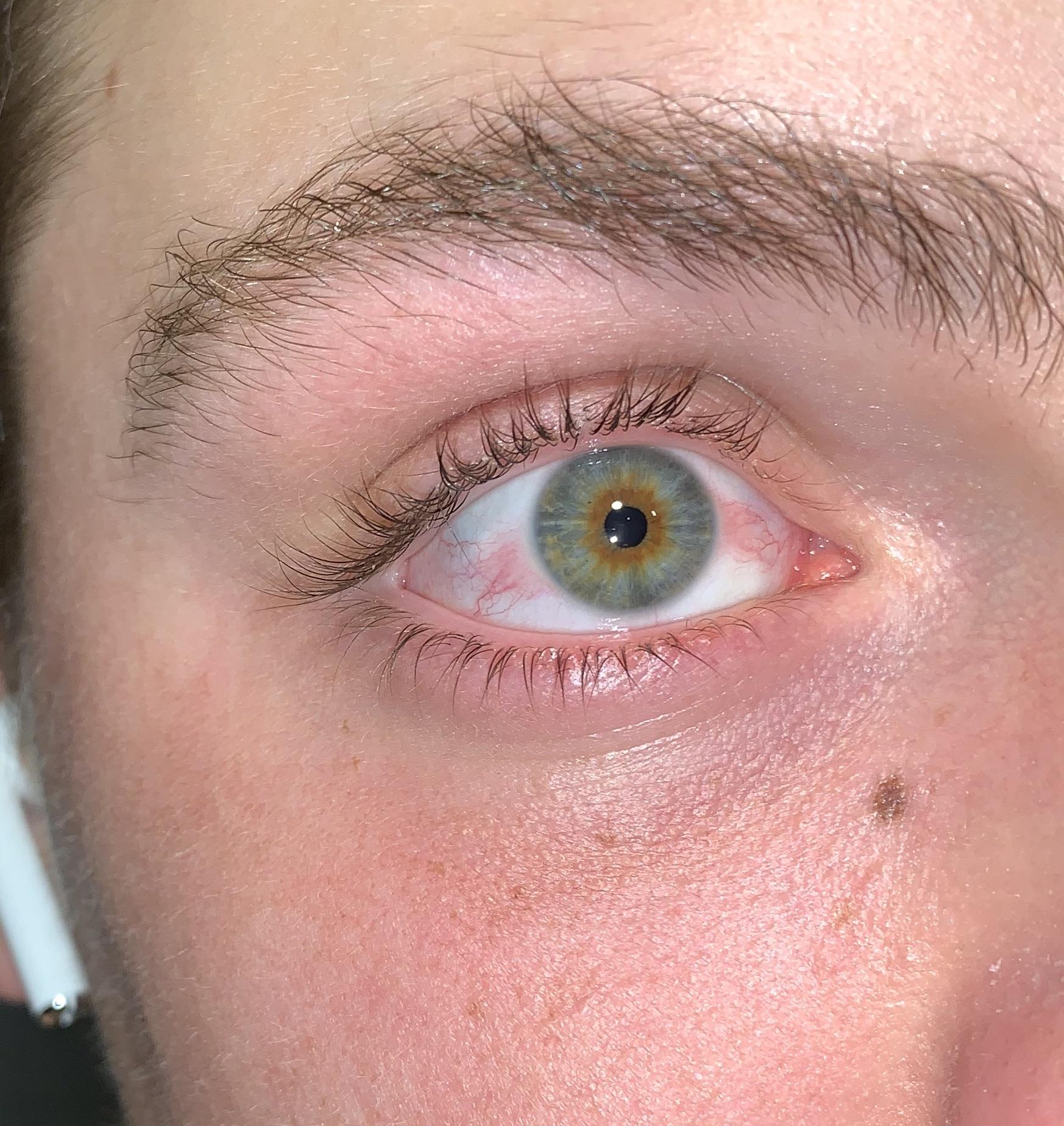 What does Xanax do to your eyes