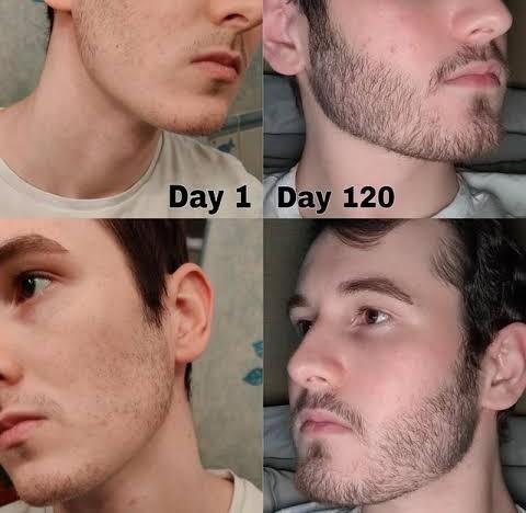 before and after minoxidil beard