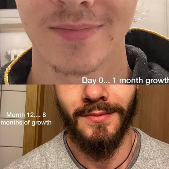 minoxidil beard before and after reddit