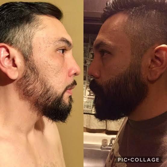 minoxidil beard before and after
