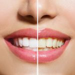 Can Doxycycline Stain Teeth In Adults 1