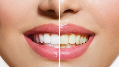 Can Doxycycline Stain Teeth In Adults