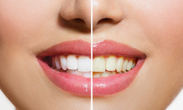 Can Doxycycline Stain Teeth In Adults