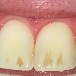 Does Tetracycline Stain Teeth In Adults
