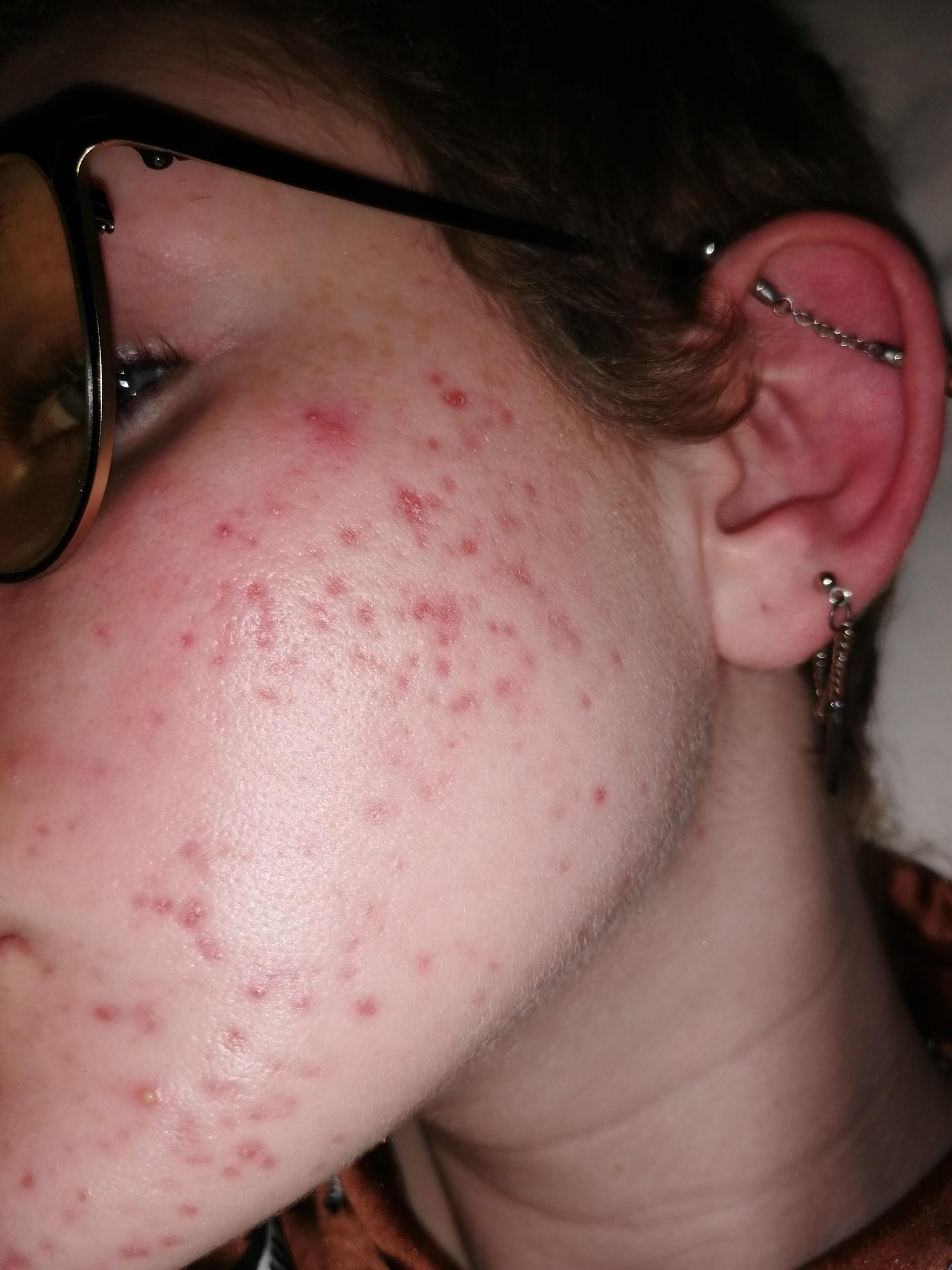 Doxycycline Ruined My Life scaled