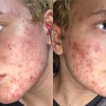 How To Use Tetracycline For Acne
