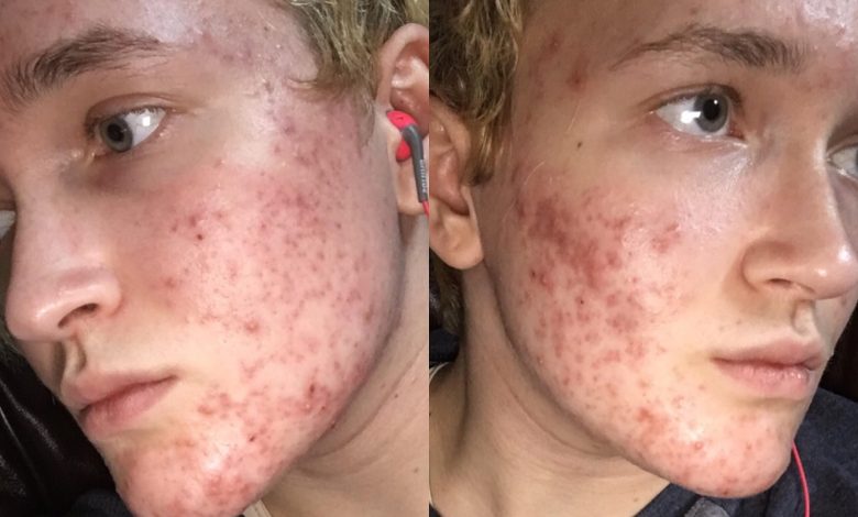 How To Use Tetracycline For Acne scaled