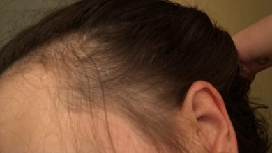 Does Telmisartan Cause Hair Loss scaled