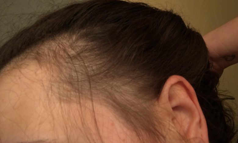 Does Telmisartan Cause Hair Loss