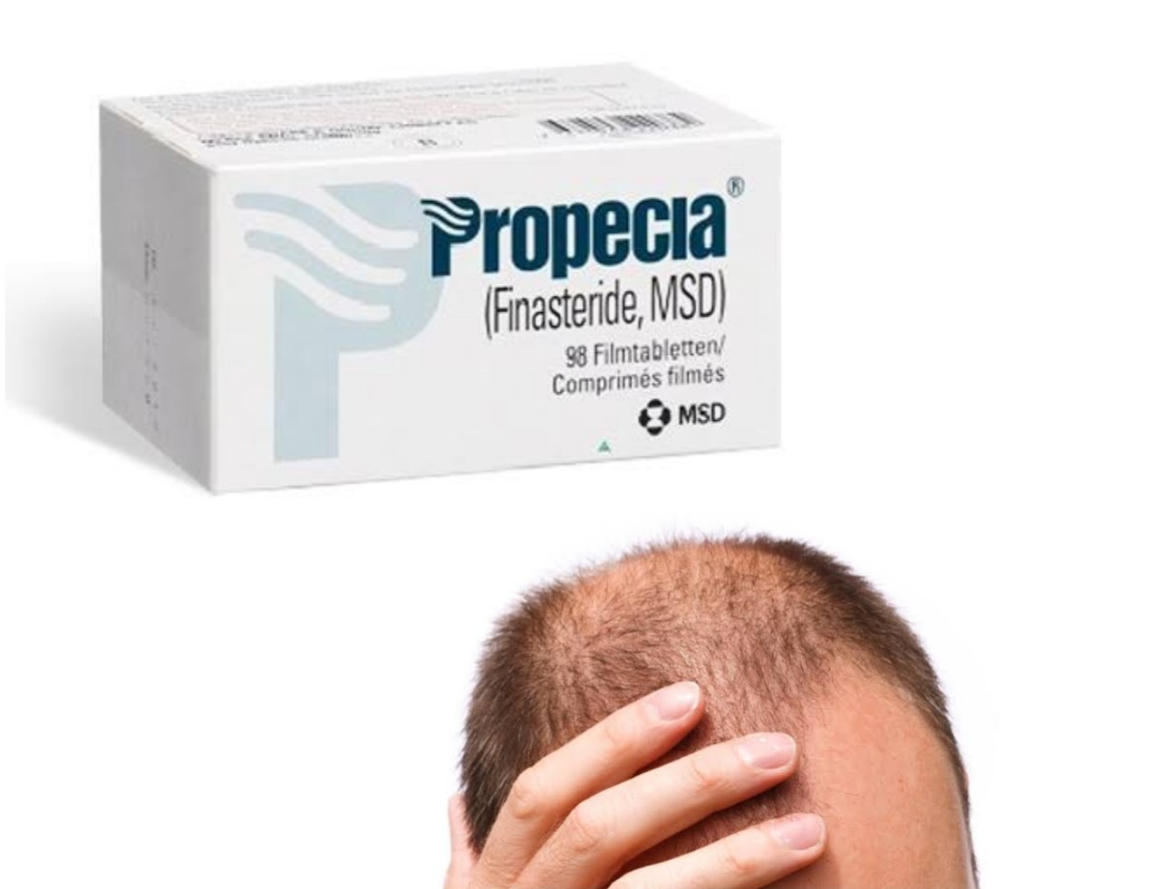 Finasteride Shedding