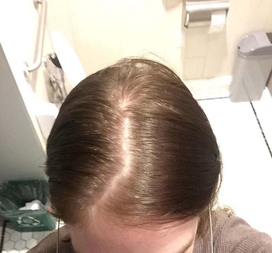 List of antidepressants that cause hair loss